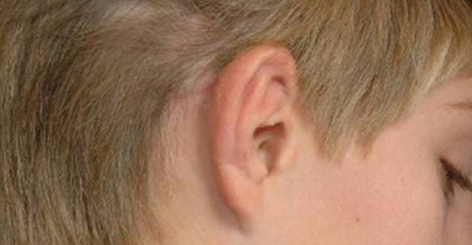 Sophono nacięcie